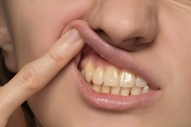 żółte zęby u kobiet