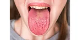 Kserostomia − skąd się bierze suchość w jamie ustnej?