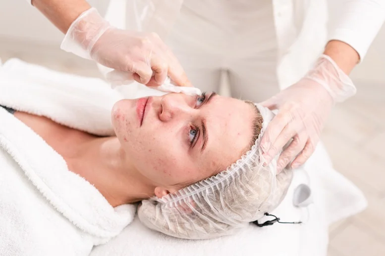 Laseroterapia skóry trądzikowej − co warto o niej wiedzieć?