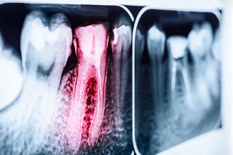 Resorpcja korzenia zęba − co to jest?