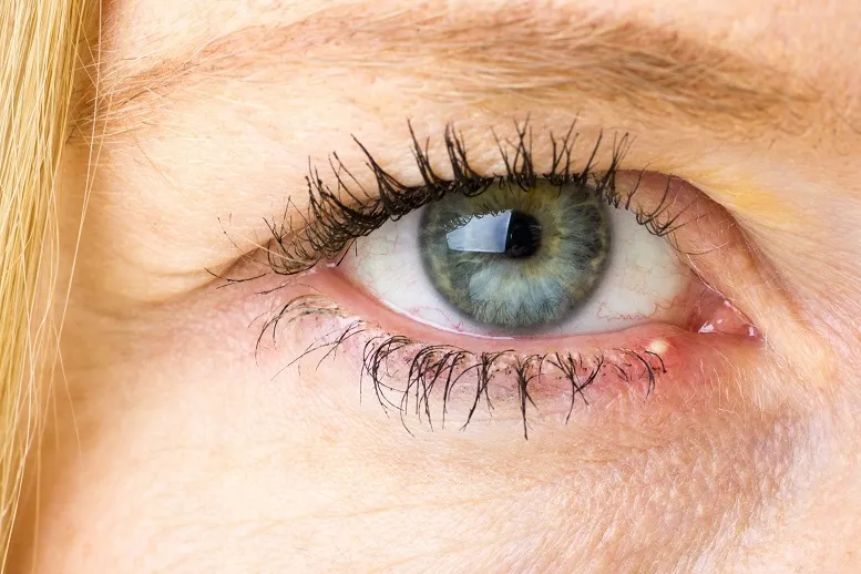 Gradówka na oku - skąd się bierze? Przyczyny i leczenie choroby aptecznymi i domowymi sposobami
