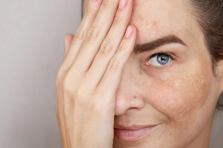 melasma melasma