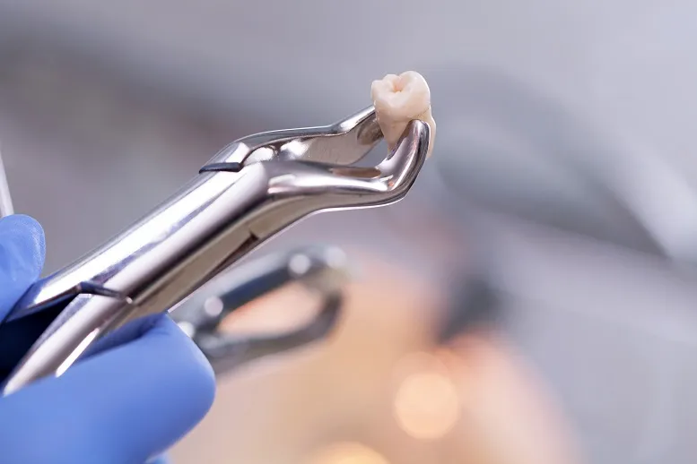 Suchy zębodół: jak mu zapobiegać po usunięciu zęba?