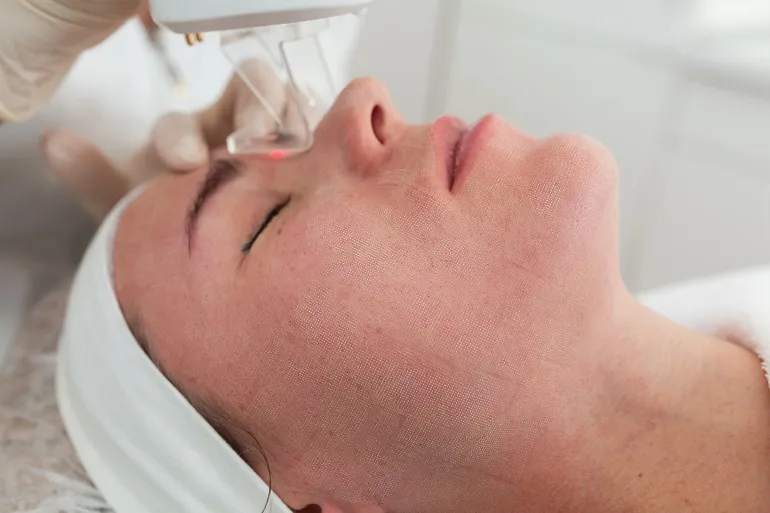 laseroterapia skóry twarzy