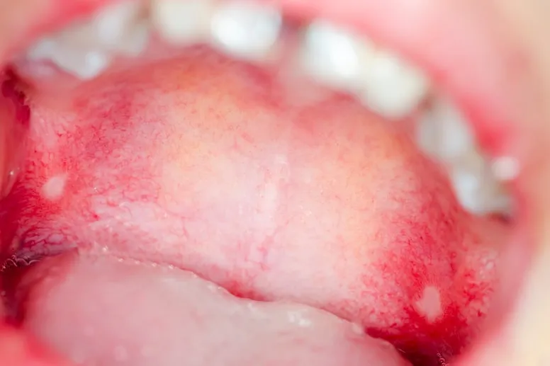 Rany w jamie ustnej leczenie