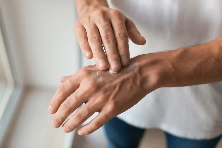 Atopowe zapalenie skóry dłoni −  jak je pielęgnować? Te składniki aktywne Ci pomogą!