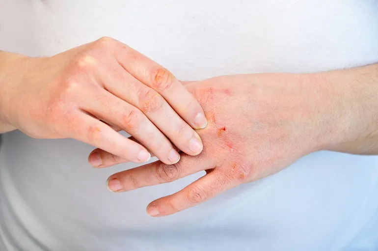 Alergiczne kontaktowe zapalenie skóry