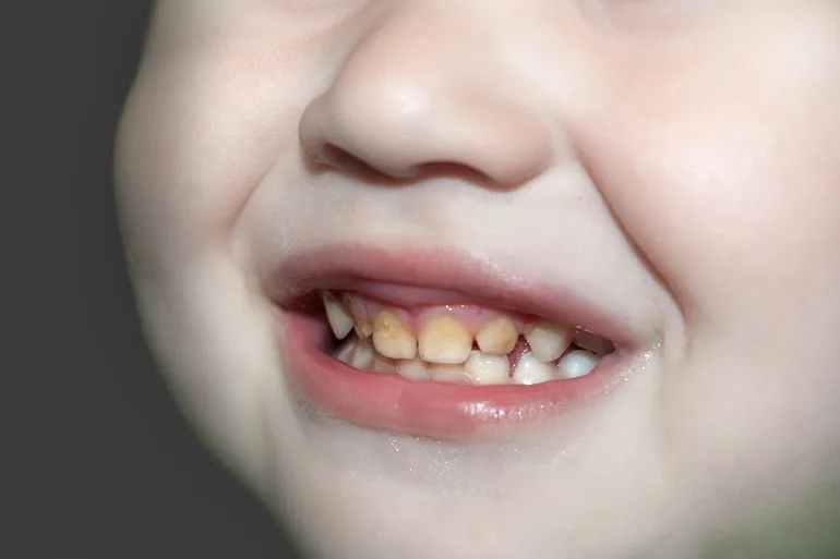 żółte zęby u dziecka przyczyny