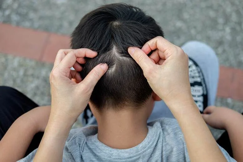 Łupież u dziecka – jakie są przyczyny i jak leczyć?