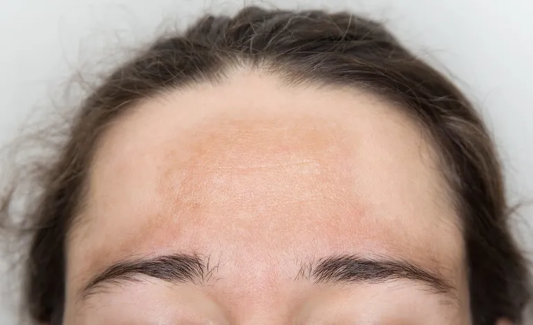 Melasma, czyli tzw. ostuda