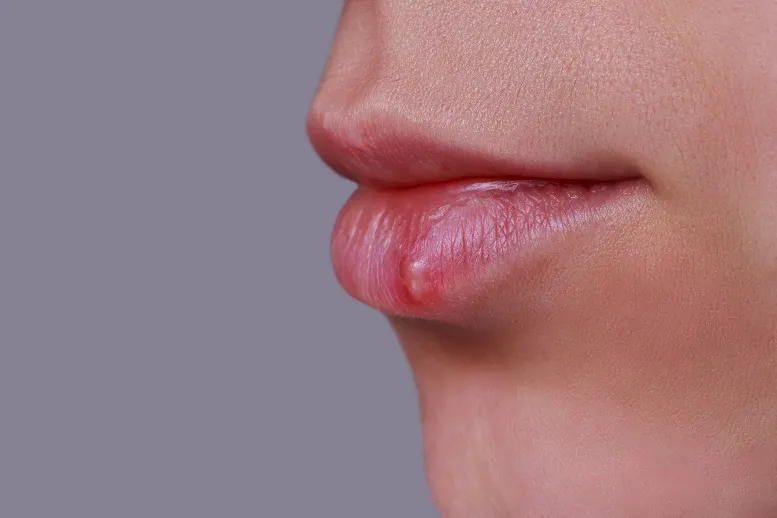 Nawracająca opryszczka na ustach: czy plastry pomogą?