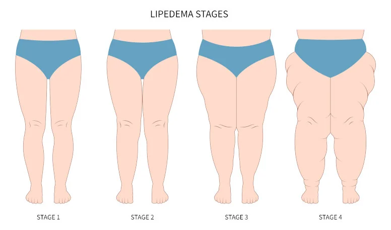 fazy lipodemii fazy lipodemii