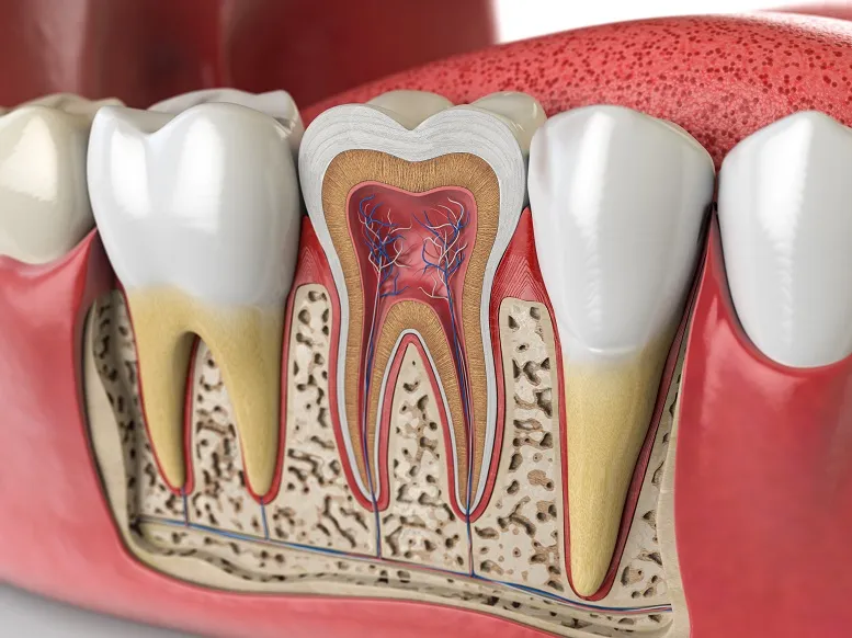 Zapalenie miazgi zęba − bolesne powikłanie próchnicy