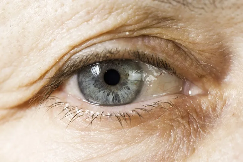 przyczyny zwyrodnienia plamki żółtej oka