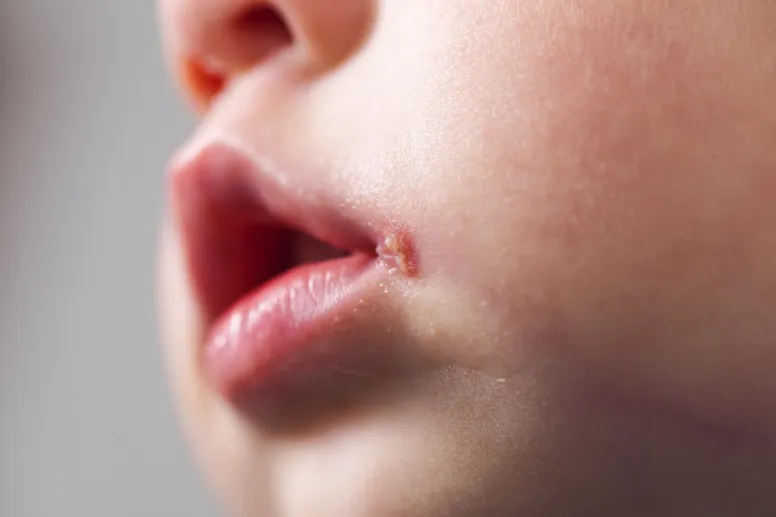 herpes en la nariz en un niño