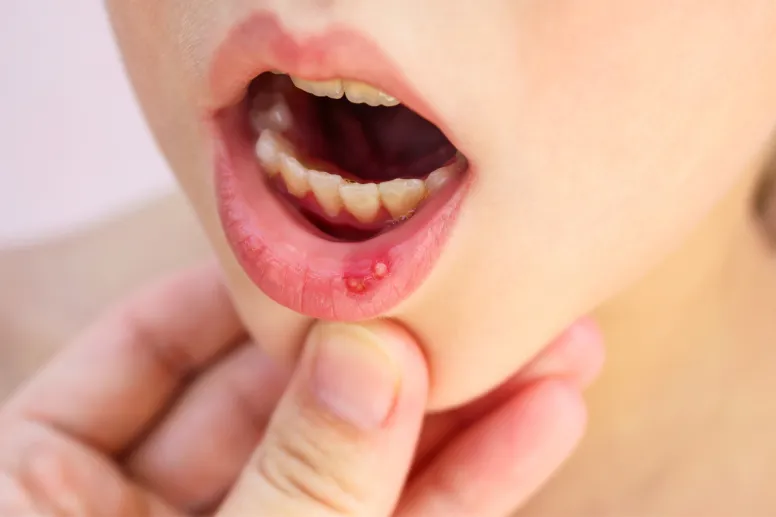 herpes en los labios en un niño