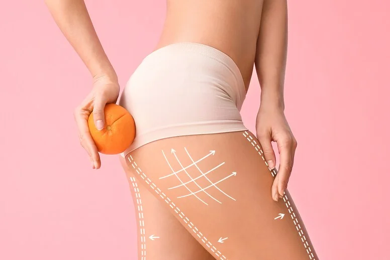 Cellulit w ciąży – jak się pozbyć? Cellulit w ciąży – jak się pozbyć?
