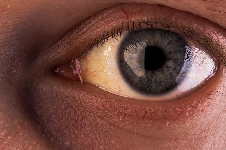 niepokojący objaw - zażółcenie białek oczu