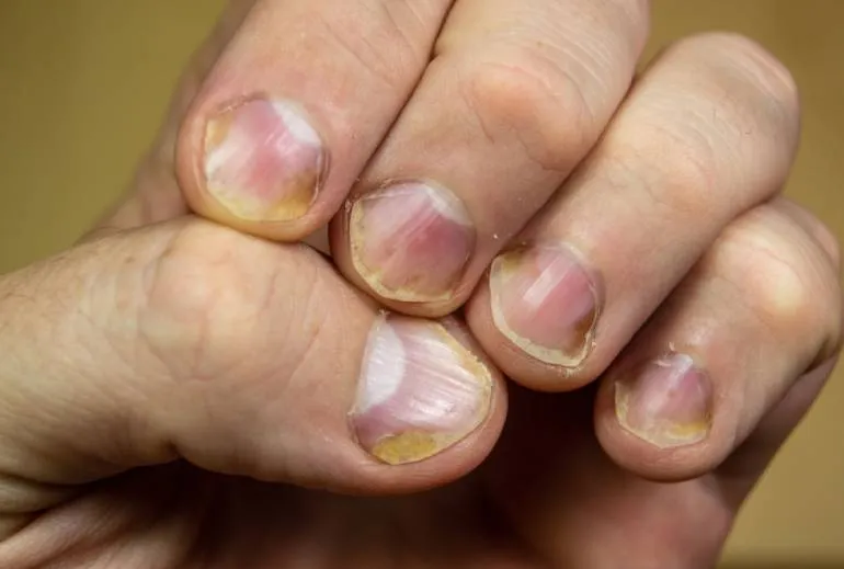 łuszczyca paznokci leczenie