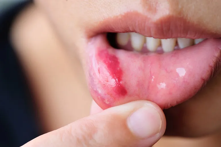 Jak radzić sobie ze stanami zapalnymi w jamie ustnej?