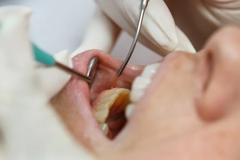 leczenie laserowe zębów