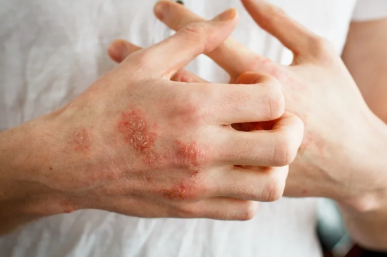 Atopowe zapalenie skóry na rękach