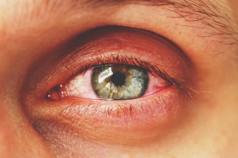 Co to jest cukrzycowa retinopatia oka