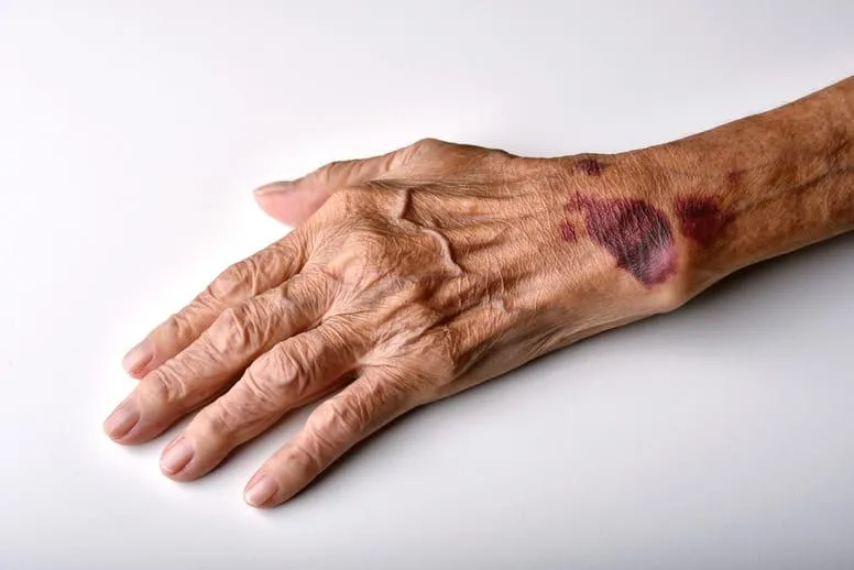 Wylewy podskórne u osób starszych – przyczyny, objawy i leczenie