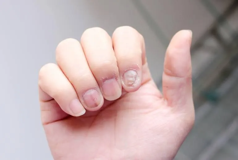 Łuszczyca paznokci – jak ją rozpoznać? Objawy i leczenie