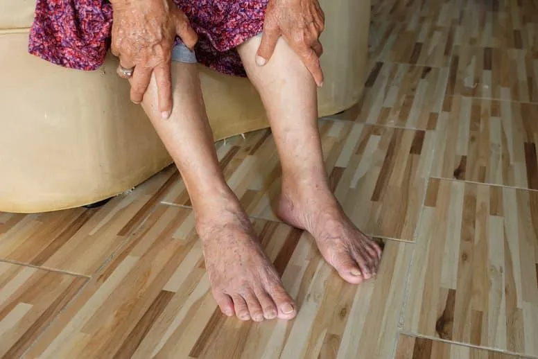 Obrzęk nóg u starszej osoby – przyczyny, objawy i leczenie