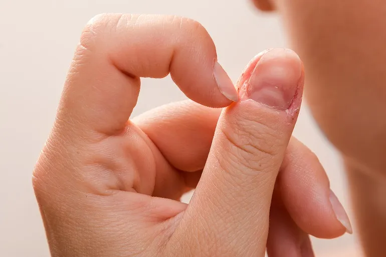 sposób na obgryzanie paznokci