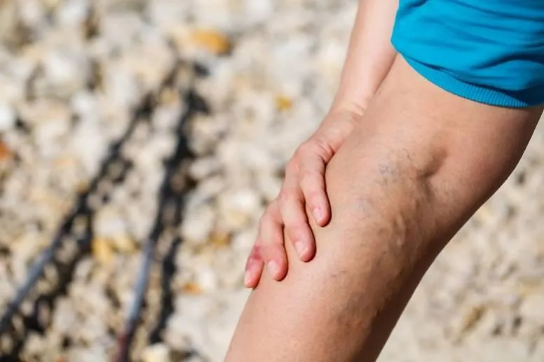 Żylaki na nogach – czy Tobie też grożą? Sprawdź, skąd się biorą