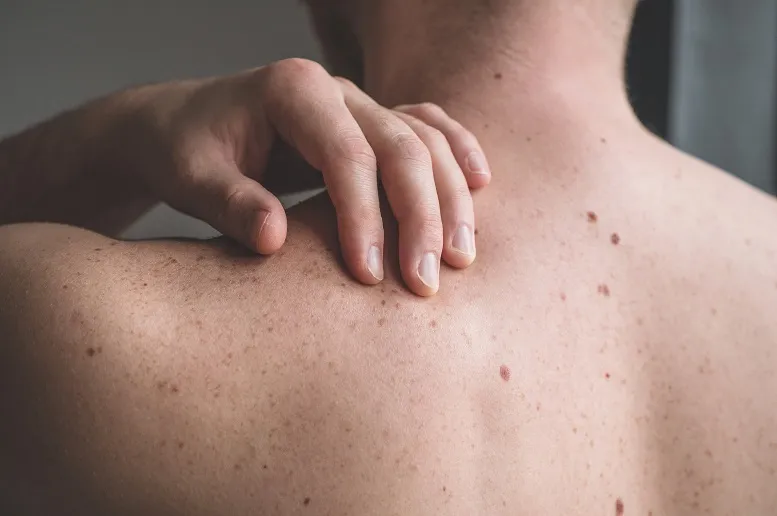 Biopsja skóry − kiedy się ją zaleca?