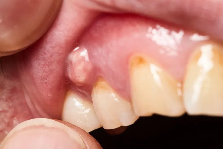ropień zęba opuchlizna policzka
