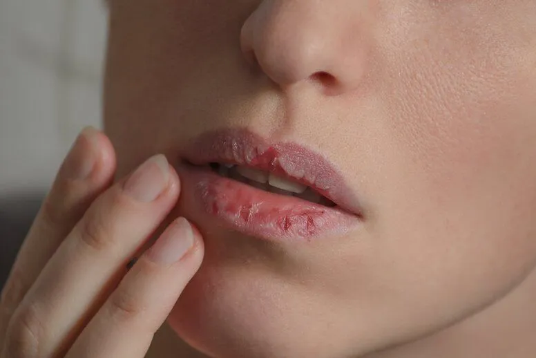 Pękające usta – przyczyny i domowe sposoby na popękane usta
