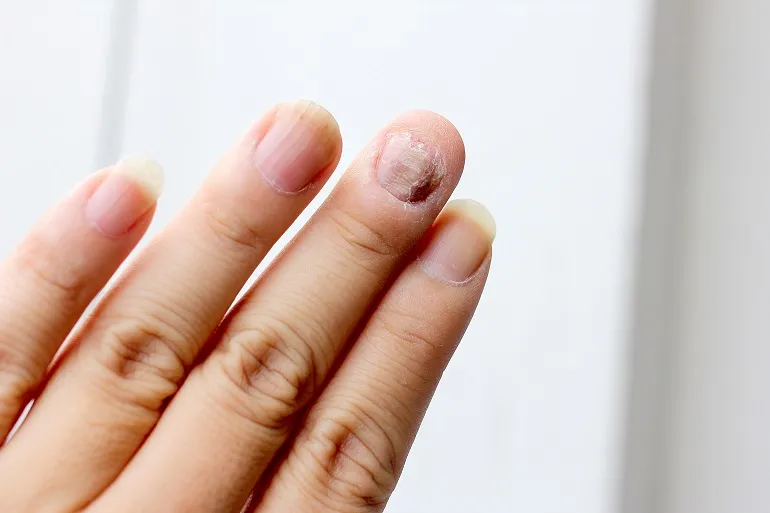 Grzybica paznokci - jak ją rozpoznać?
