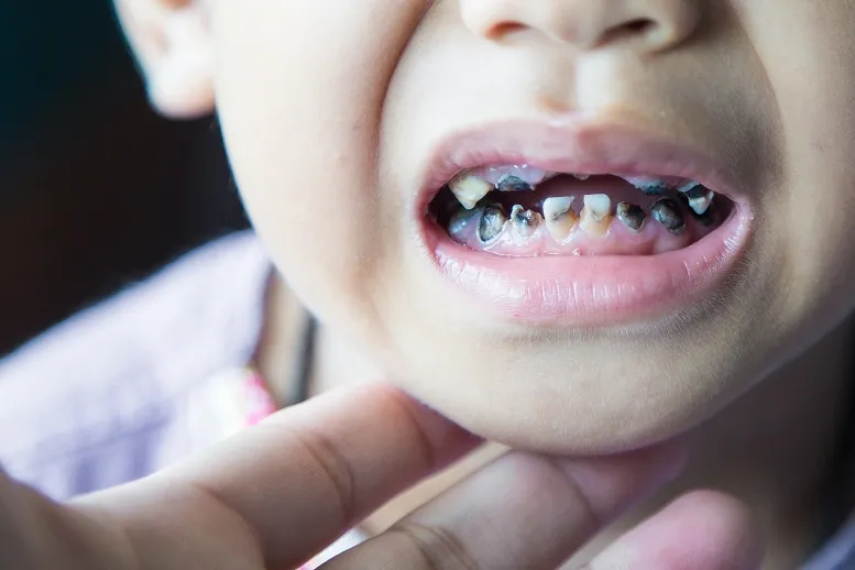 próchnica zębów mlecznych u dziecka