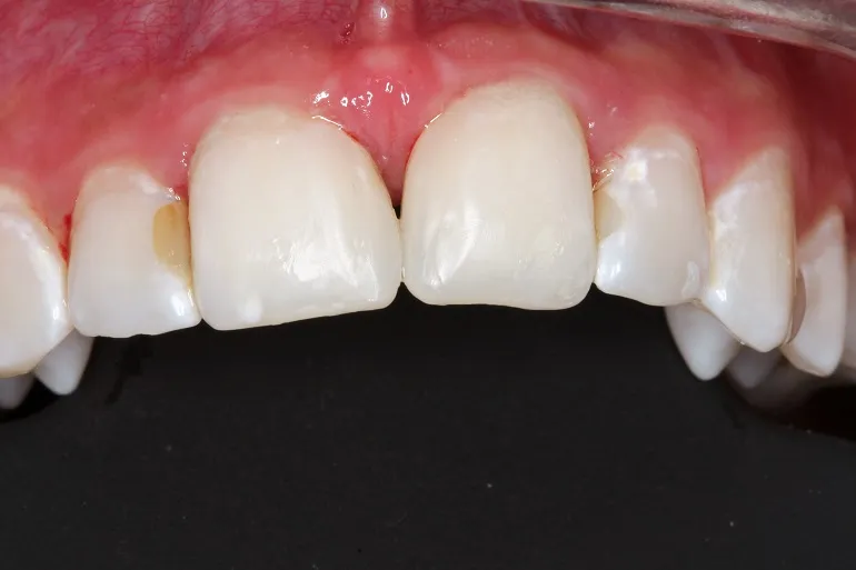 hipoplazja zębów
