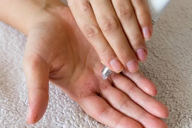 Pękająca skóra między palcami − poznaj jej przyczynę! AZS, grzybica, a może zła pielęgnacja?