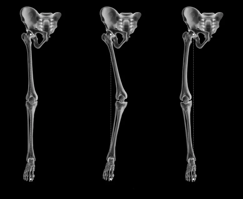 osteomalacja a osteoporoza