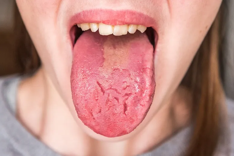 Kserostomia − skąd się bierze suchość w jamie ustnej?