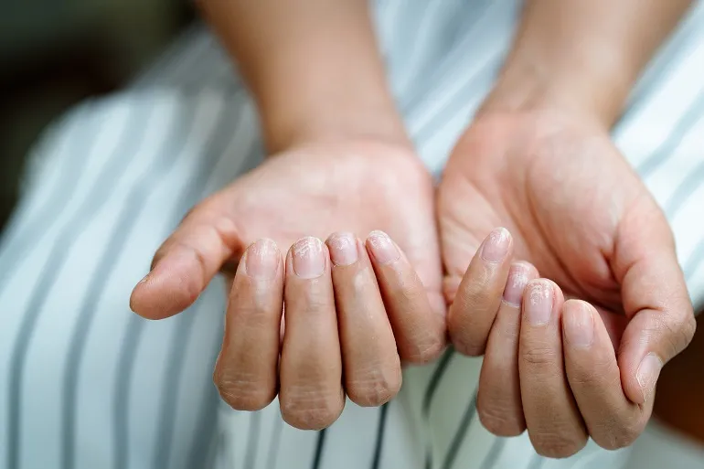 Rozdwajające się paznokcie - sposoby pielęgnacji