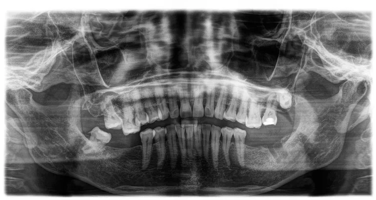 ząb zatrzymany - rentgen 