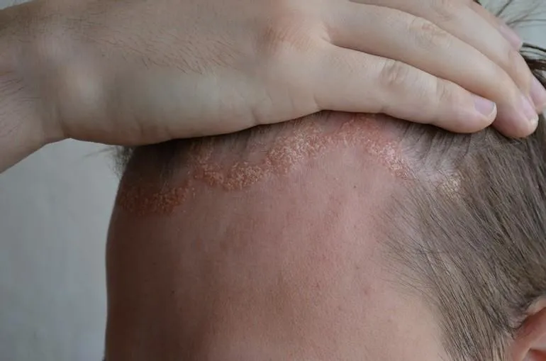 Łuszczyca skóry głowy − leczenie ogólne, miejscowe i domowe sposoby