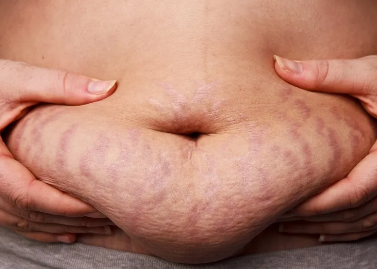 tatuaż po ciąży przeciwwskazania