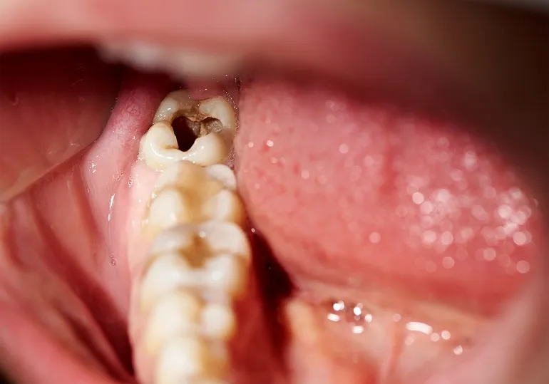 zęby niedobór fluoru