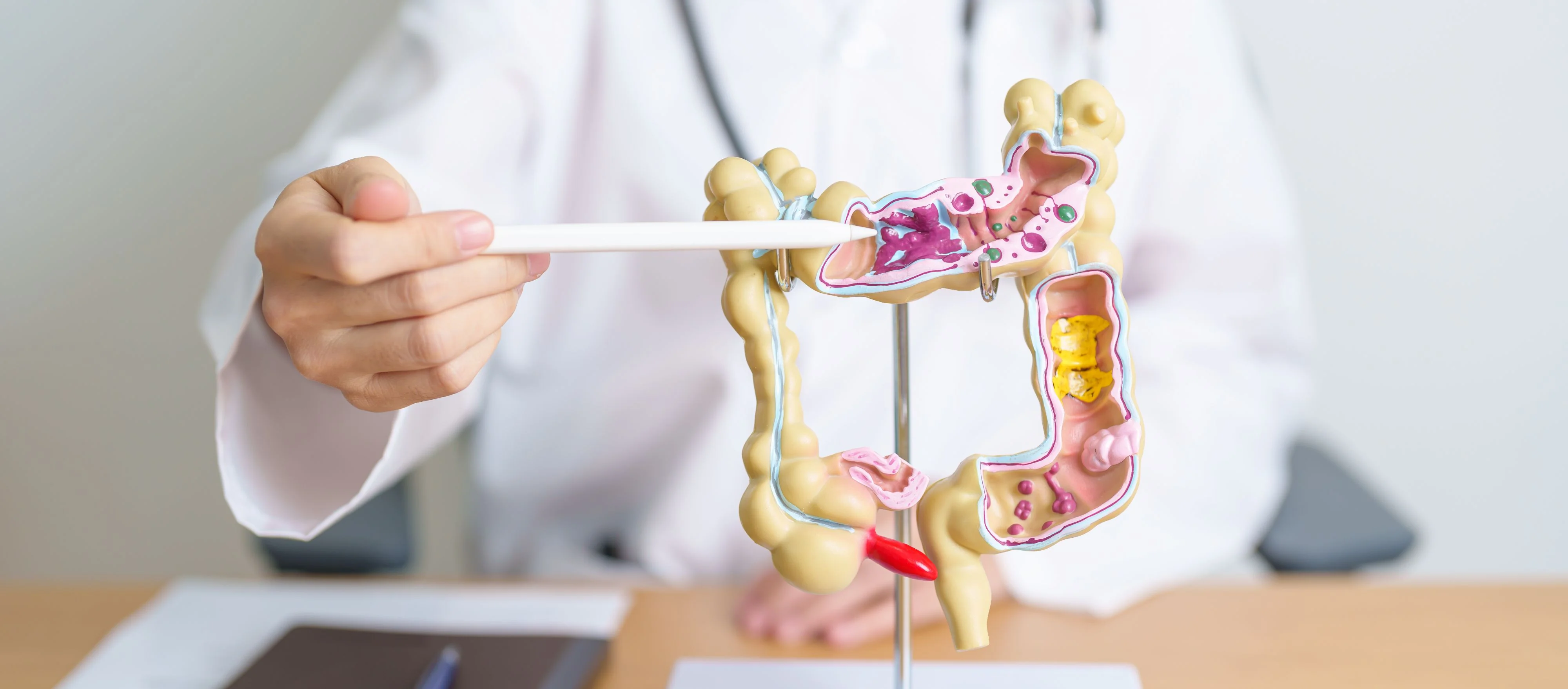 Gruczolak jelita grubego - co to jest? Objawy, diagnostyka, leczenie
