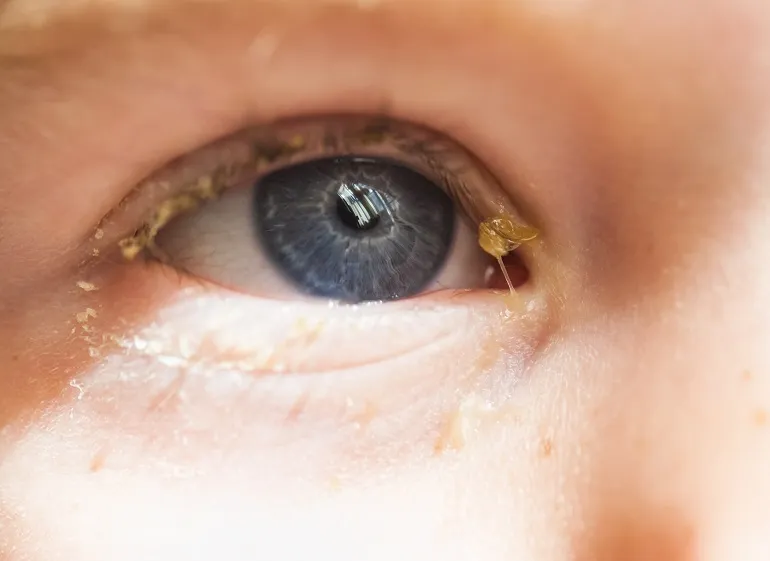Dlaczego dziecku ropieją oczy