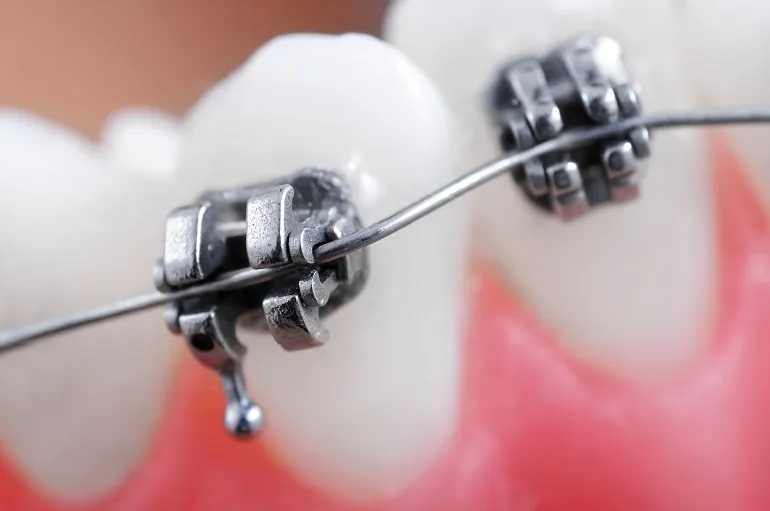 Ruszające się zęby u dorosłych - aparat ortodontyczny