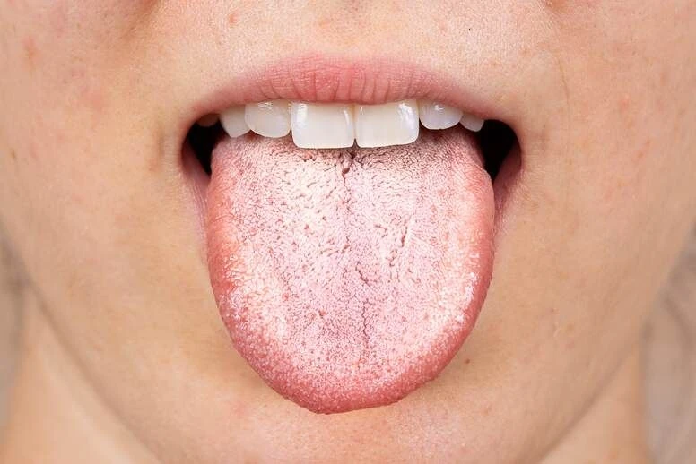 Biały nalot na języku – przyczyny, leczenie i domowe sposoby